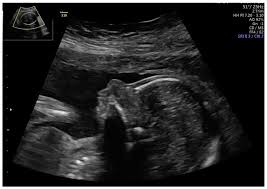 Fetal Profile At 20 Weeks With Absent Nasal Bone. | Download Scientific  Diagram