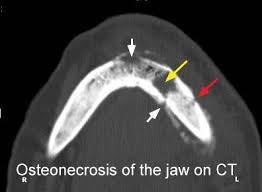 Medication-Related Osteonecrosis Of The Jaw | Radiology Reference Article |  Radiopaedia.Org