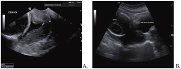 Cervical Funneling (Effacement)